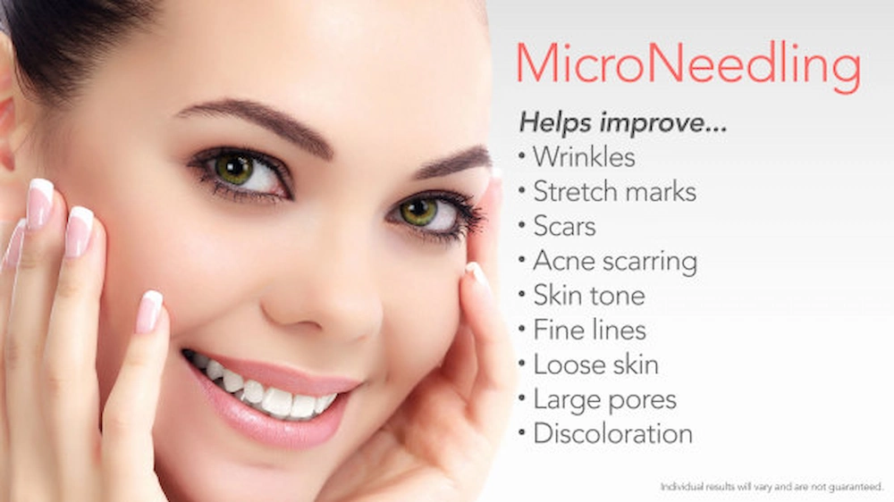 microneedling