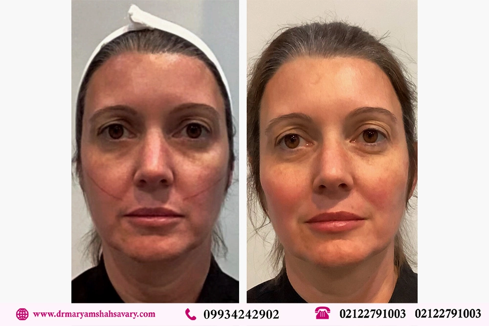 عکس های لیفت صورت با نخ