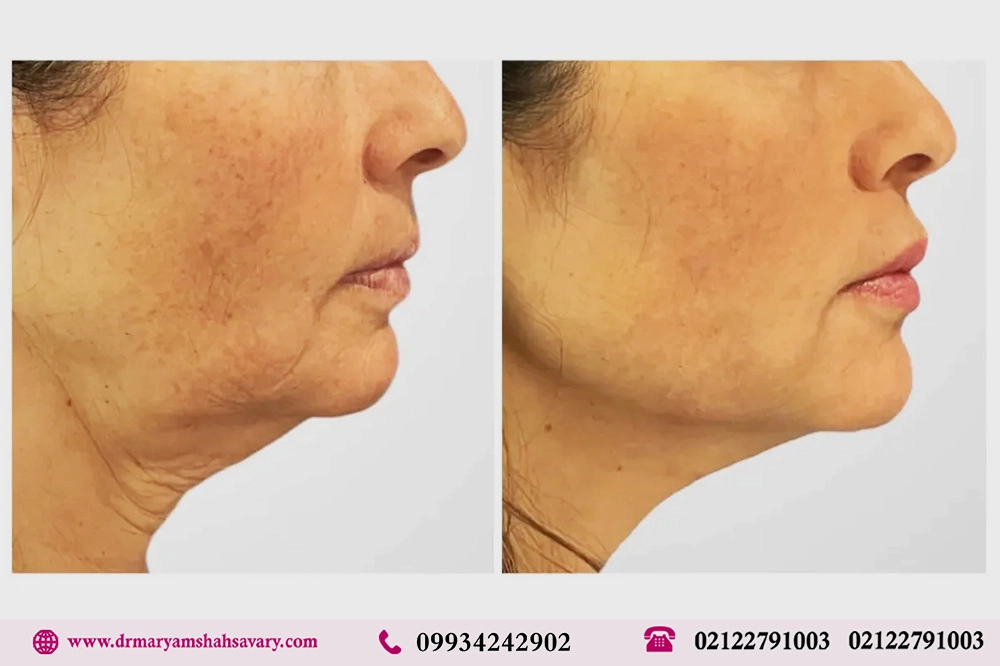 عکس های لیفت صورت با نخ