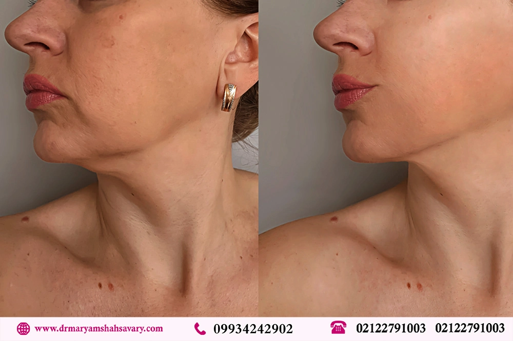 نمونه کار لیفت صورت با نخ