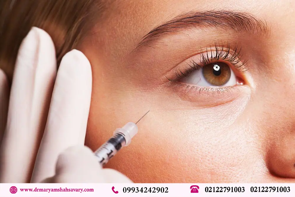 تزریق بوتاکس زیر چشم