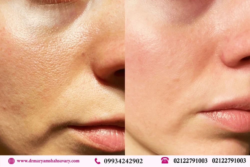 عکس فیشیال صورت قبل و بعد