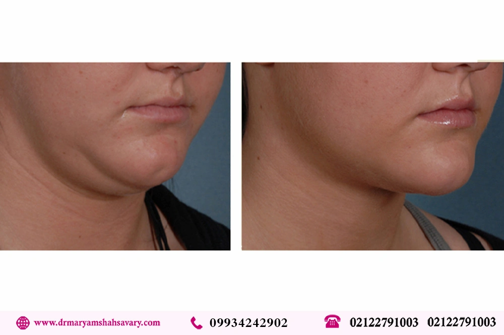 نمونه کار های لیپوساکشن غبغب در تهران