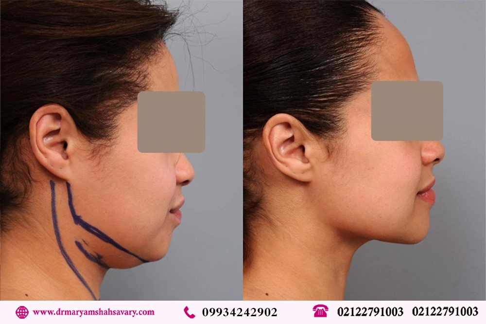 عکس قبل و بعد لیپوساکشن غبغب در تهران