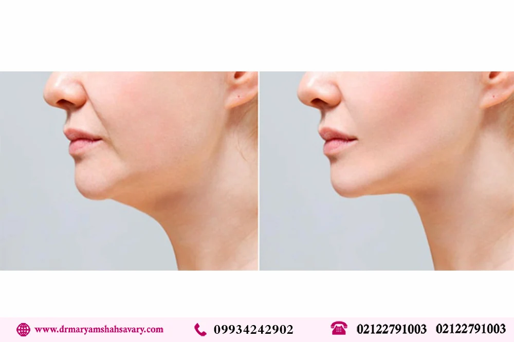 درمان غبغب فوری