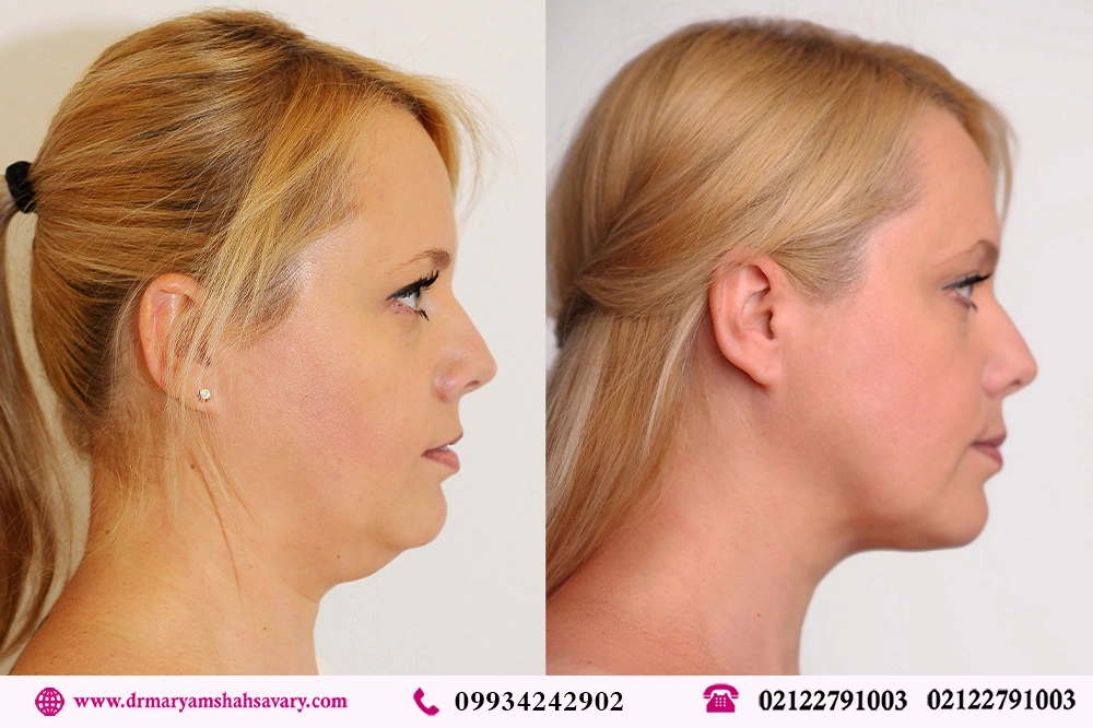 عکس های قبل و بعد لیپوساکشن غبغب در تهران