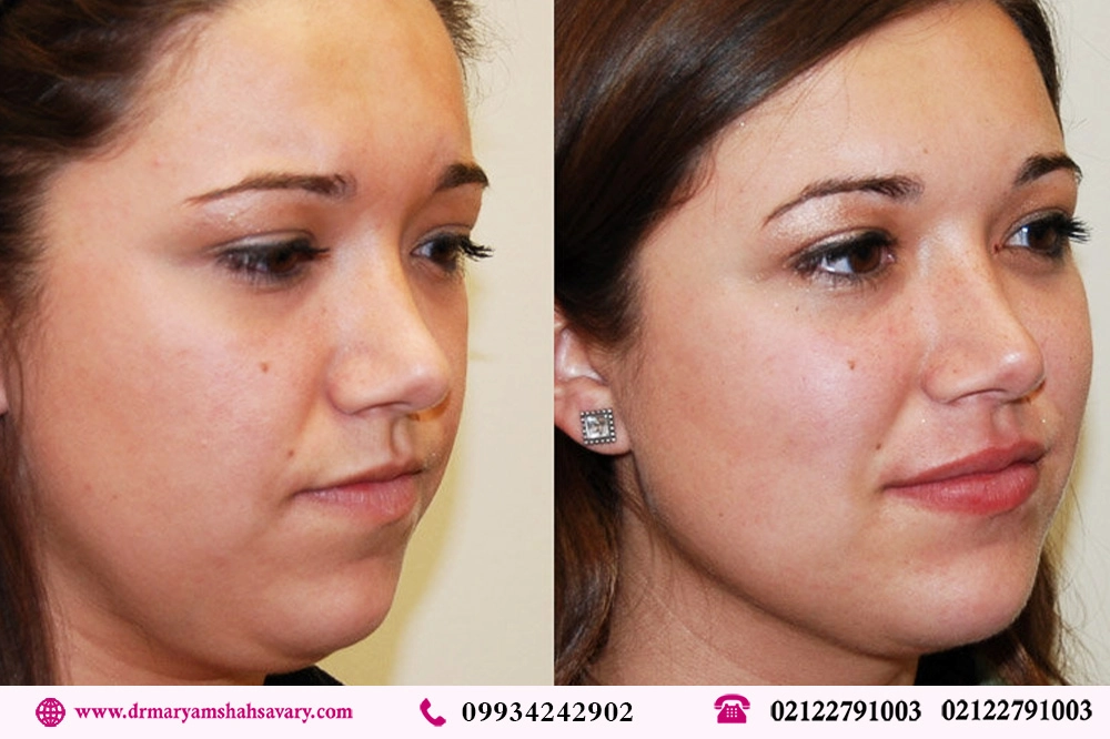 عکس های لیپوساکشن غبغب قبل و بعد