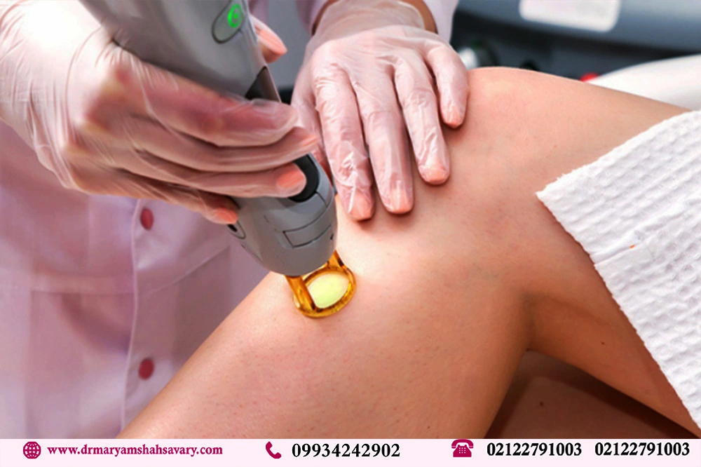لیزر موهای زائد در فرمانیه تهران